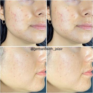 IS CLINICAL Active Serum - Tinh chất đặc trị mụn, lỗ chân lông & dầu thừa image 4