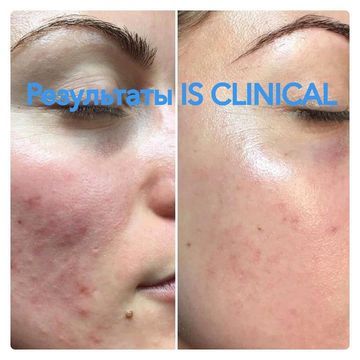 IS CLINICAL Pro-Heal Serum Advance+ - Tinh chất trị mụn, giảm thâm, làm dịu kích ứng & chống lão hoá image 3
